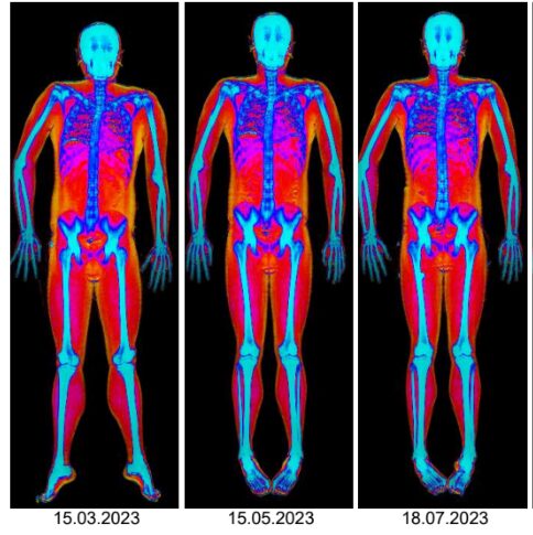eric's dexa scans