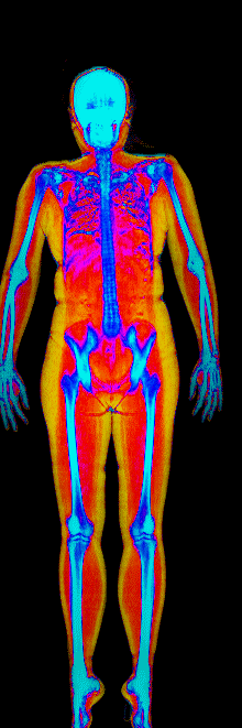 Female DEXA scan at 40.0% body fat