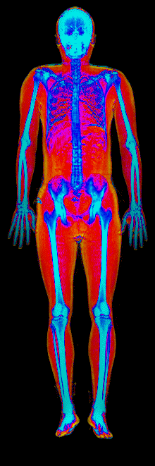 Male DEXA scan at 22.4% body fat