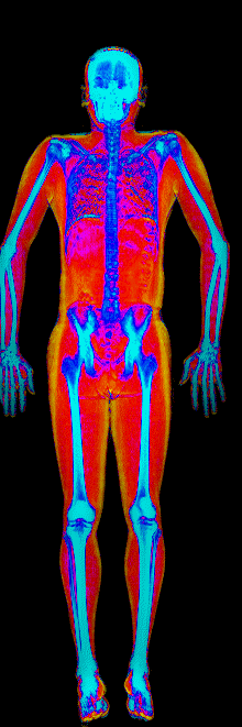 Male DEXA scan at 25.0% body fat