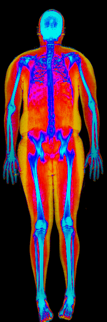 Male DEXA scan at 35.0% body fat