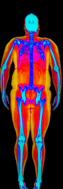 Male DEXA scan at 40.0% body fat