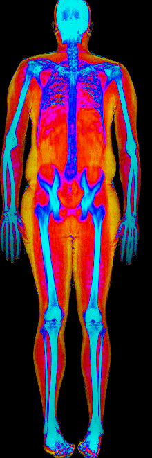 Male fat loss number 2 DEXA scan before at 225 lb