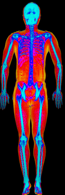 Male muscle gain number 3 DEXA scan before at 173 lb