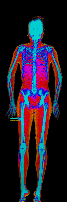 Emma DEXA body composition scan at 126 lb and 20.4 percent body fat after losing 22.7 lb of fat and gaining 1.7 lb lean