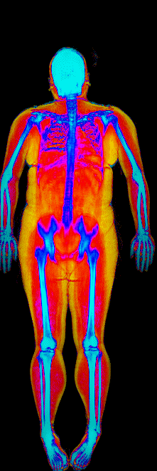 Female fat loss number 2 DEXA scan before at 201 lb and 39.3 percent body fat