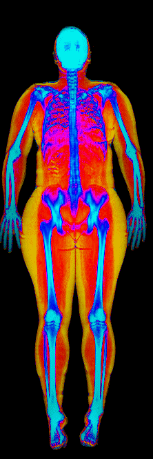 Female fat loss number 3 DEXA scan before at 183 lb and 40.5 percent body fat