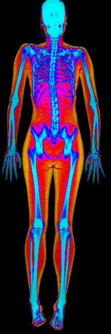 Female muscle gain number 3 DEXA scan before at 140 lb and 29.3 percent body fat