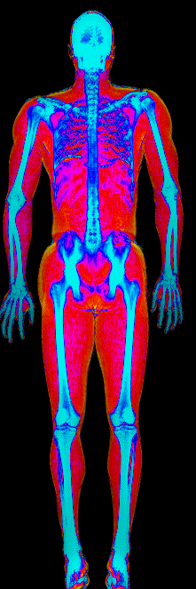 Kevin DEXA body composition scan at 177 lb and 15.1 percent body fat after gaining 10.7 lb of lean mass
