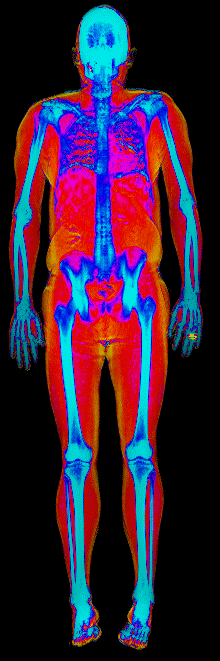 Matt DEXA scan after at 179 lb and 22.3 percent body fat with 423 grams visceral fat