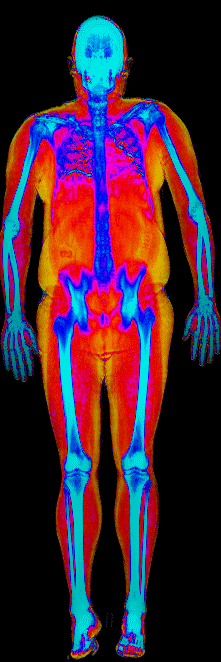 Matt DEXA scan before at 205 lb and 30.6 percent body fat with 845 grams visceral fat