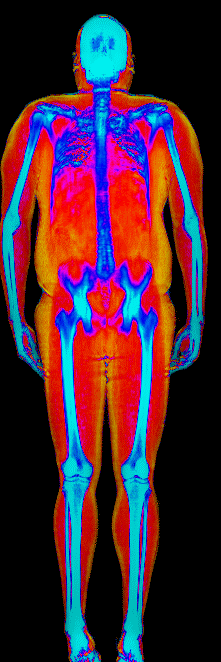 Male fat loss number 1 DEXA scan before at 240 lb and 30.9 percent body fat