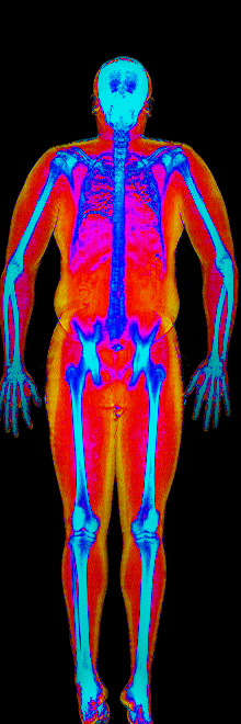 Male fat loss number 3 DEXA scan before at 186 lb and 25.4 percent body fat