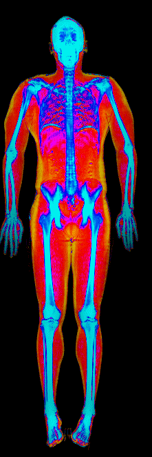 Male muscle gain number 1 DEXA scan before at 158 lb and 23.6 percent body fat