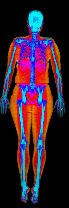 Nora DEXA scan after at 150 lb and 30.8 percent body fat showing visceral fat dropped to 268 grams