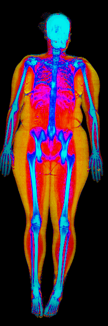 Nora DEXA scan before at 187 lb and 38.7 percent body fat showing visceral fat at 525 grams