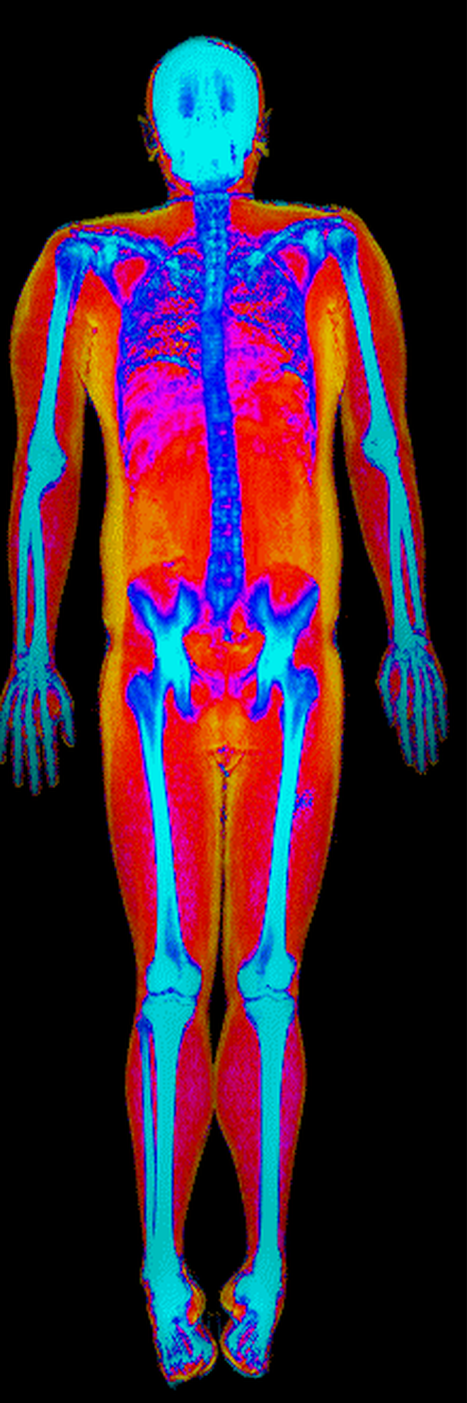 Anonymized Hologic dashboard colour DEXA scan example reported at 28.9 percent body fat.